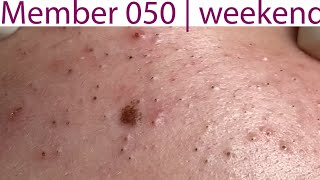 Acne Treatment Huong Da Nang 050  weekend  2023 [upl. by Proudlove]