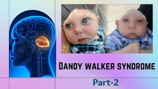 DANDY WALKER SYNDROME  PART2  PEDIATRIC NEUROLOGY  CONGENITAL BRAIN MALFORMATION [upl. by Luapleahcim]