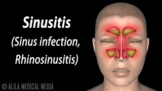 Sinusitis Animation [upl. by Gaile]