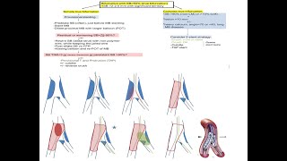 Coronary bifurcation stenting modern algorithms and details of provisional techniques Elias Hanna [upl. by Nnayd920]