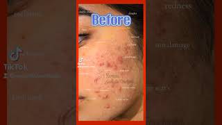 mesotherapy treatment before and after skincare acnescarremoval beforeandafter skincare results [upl. by Ahsytal]