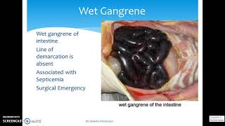 DIFFERENT TYPES OF GANGRENE [upl. by Modla]