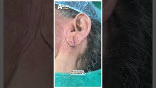 Ear Piercing Before amp After See the Difference Awish Clinic [upl. by Sutphin608]