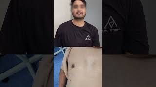 Gynecomastia In Lucknow  Gynecomastia Surgery Result Grade 2 Gynecomastia surgery lucknow [upl. by Iphigenia]