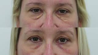 Xanthelasma removal treatment demo and results  see beforeafter photos [upl. by Hassin]