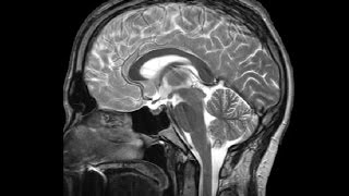 The Ventricles Neuroanatomy Video Lab  Brain Dissections [upl. by Admana]