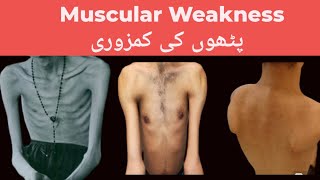 Muscular Weakness and Fatigue Pathophysiology Causes Symptoms Diagnostic Test and Treatment Plan [upl. by Harrell]