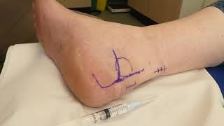 Injection  pre Achilles bursa [upl. by O'Connell]