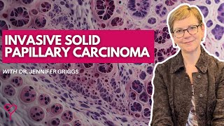 What is Invasive Solid Papillary Carcinoma and How is it Treated [upl. by Ecila]