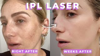 IPL  CLEAR AND BRILLIANT LASER REVIEW  What are they Are they painful Is it worth it [upl. by Eillom]