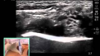 UltrasoundGuided Supraclavicular Brachial Plexus Nerve Block  SonoSitemp4 [upl. by Pogue]