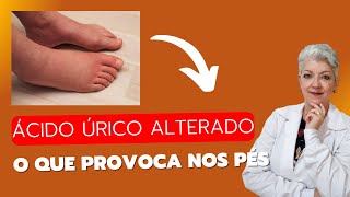 ÁCIDO ÚRICO Alterado O que pode provocar nos PÉS [upl. by Eatnahc]