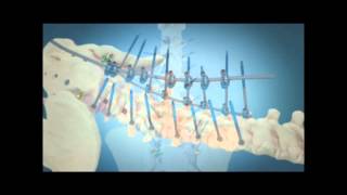 Scoliosis Surgical Correction with Instrumentation [upl. by Odille]