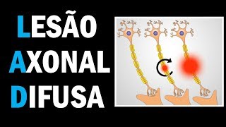 LESÃO AXONAL DIFUSA LAD  DAD  TCE 5 [upl. by Nonnarb]