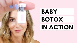 Baby Botox  Using a Dermastamp for Microneedling [upl. by Alilad]