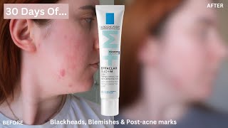 La Roche Posay Effaclar Duo Review  Worth it [upl. by Eerac]