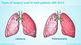 Stage 1 Lung Cancer Symptoms Treatment amp Life Expectancy  Episode 6 [upl. by Nyraf458]