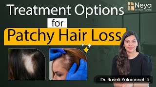 Patchy hair loss Treatment  Alopecia Areata  Hair Fall Treatment in Hyderabad [upl. by Lauritz247]