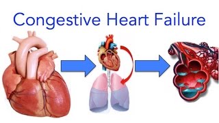 Congestive Heart Failure CHF Explained  MADE EASY [upl. by Onfre]