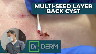 MultiSeed Layer Back Cyst  Dr Derm [upl. by Berlyn]