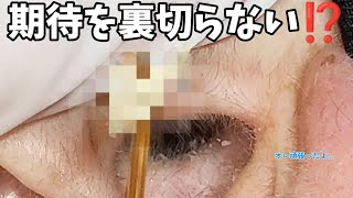 【耳掃除】104 耳かき 〜両耳バージョンまた右耳から……〜 earwax [upl. by Ahsial]